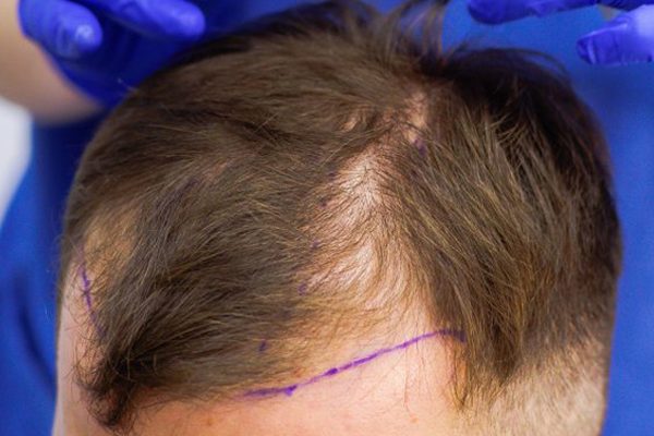 Geheimratsecken auffüllen