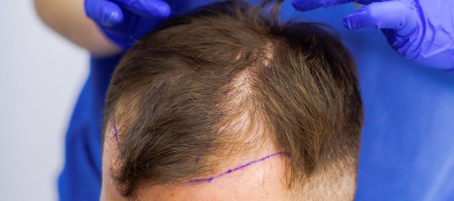 Geheimratsecken auffüllen