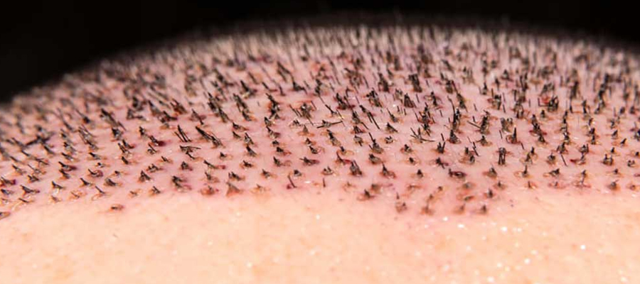 grafts